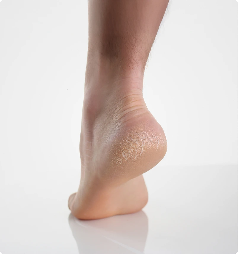 Causes of Cracked Heels Treatment Novi, MI Banner
