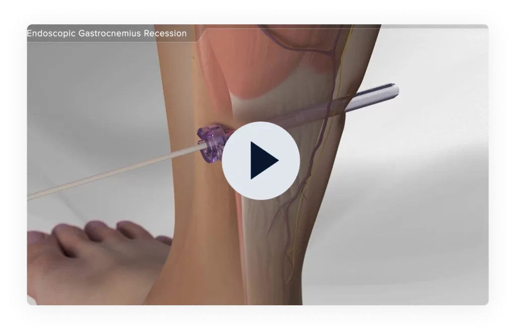 Our Treatments for Plantar Fasciitis Banner