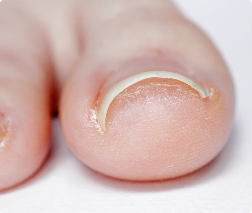 Initial Consultation For Ingrown Toenail Treatment Novi, Michigan Banner