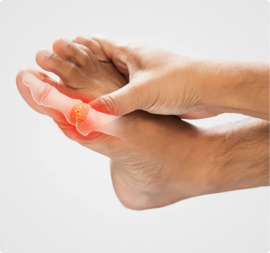 What Is Gout Treatment Novi, MI Banner