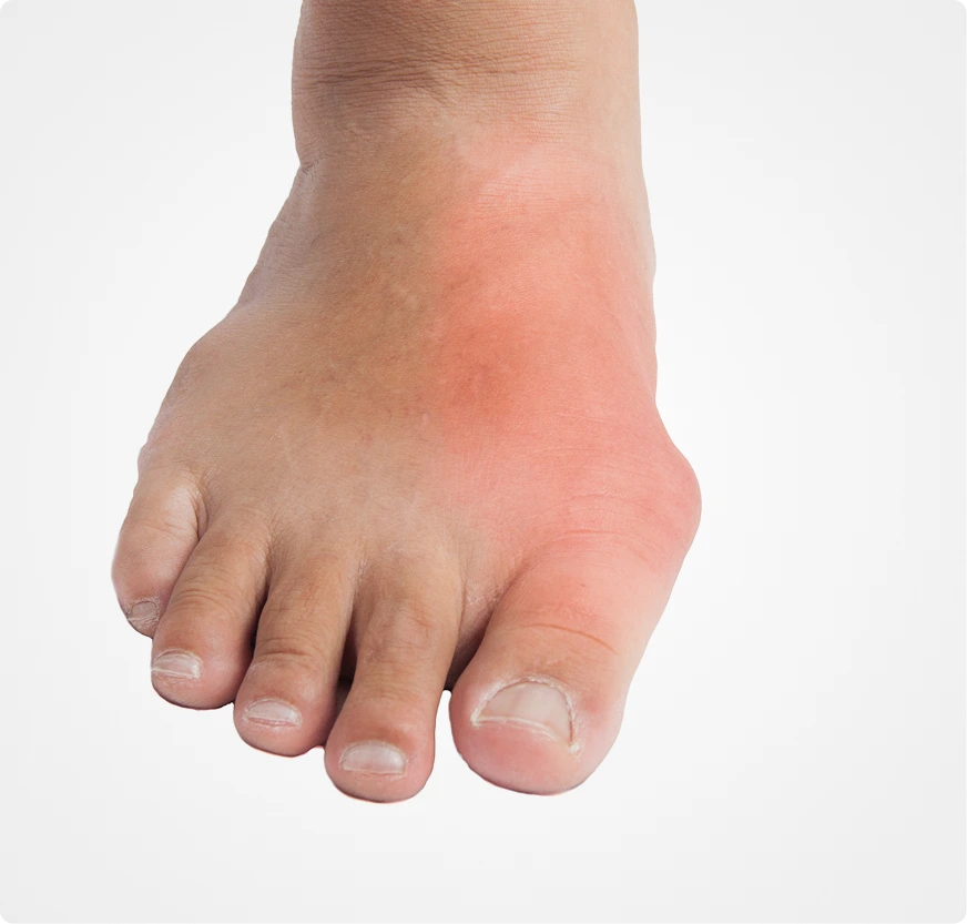 Candidates for Hallux Rigidus Treatment in Novi, MI Banner
